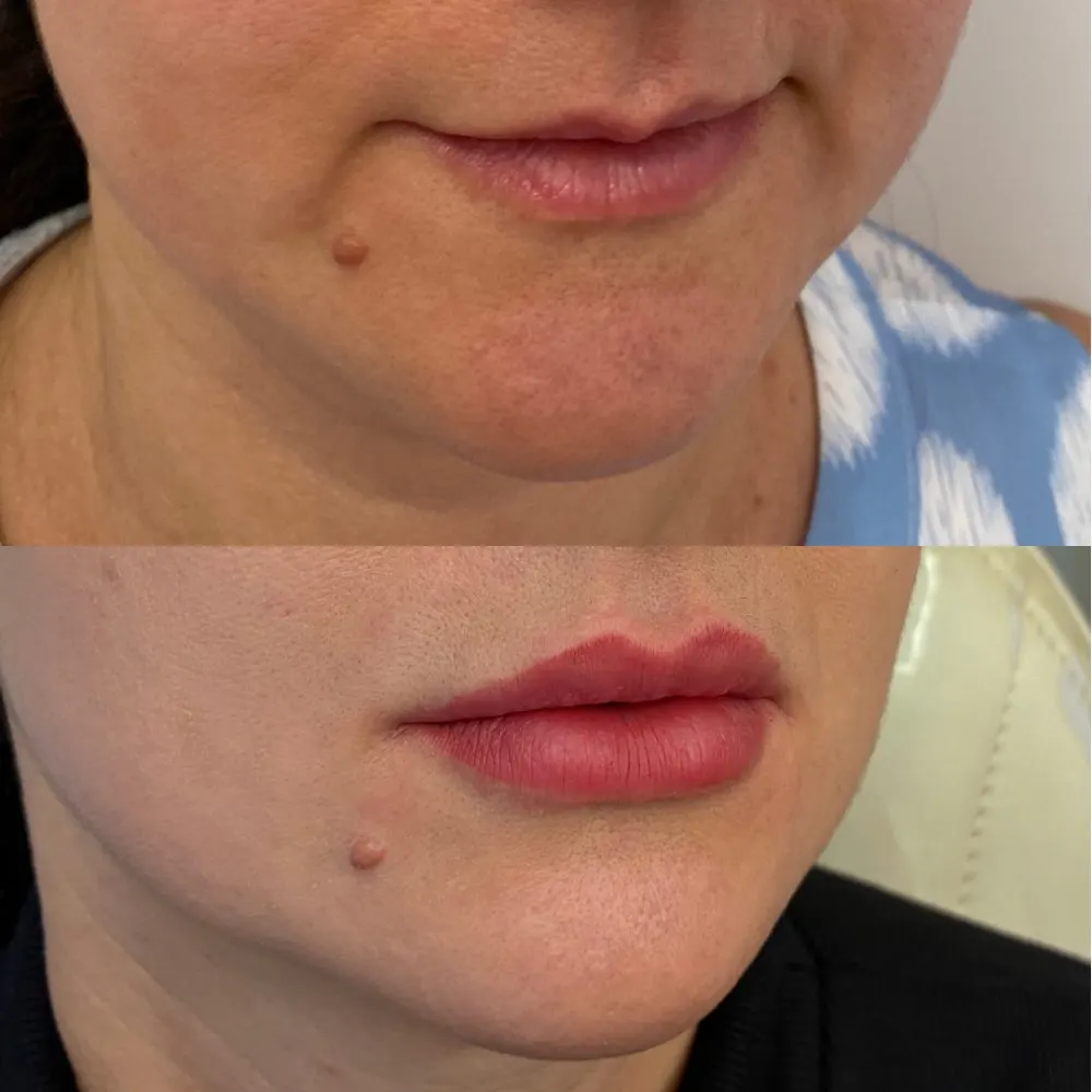 Antes e depois de tratamento facial na Cute & Capelli