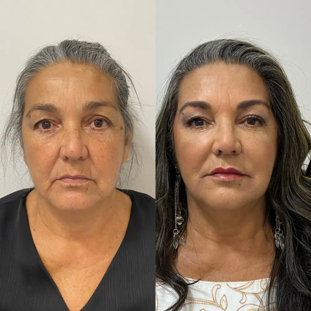 Antes e depois de tratamento facial na Cute & Capelli