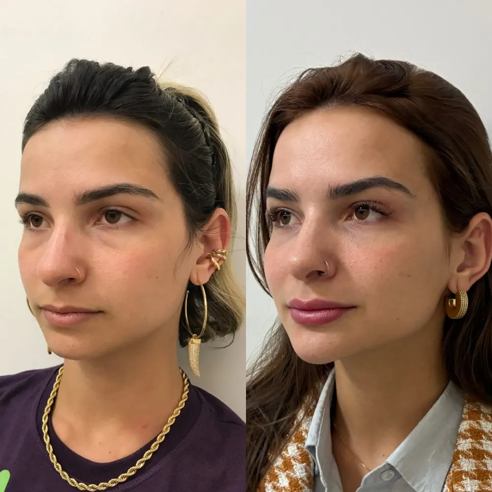Antes e depois de tratamento facial na Cute & Capelli
