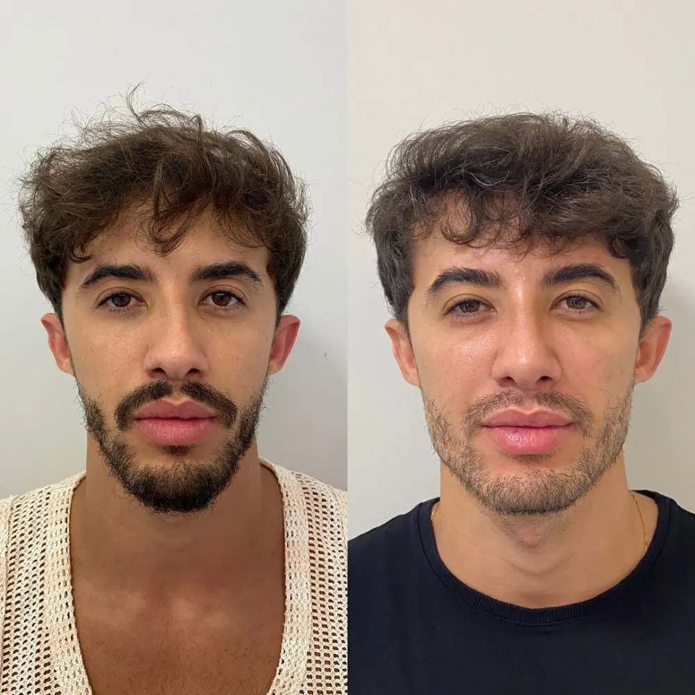 Antes e depois de tratamento facial na Cute & Capelli