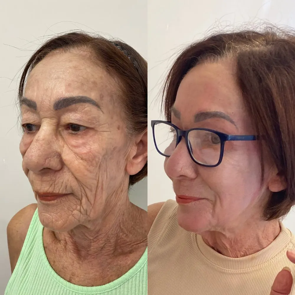 Antes e depois de tratamento facial na Cute & Capelli