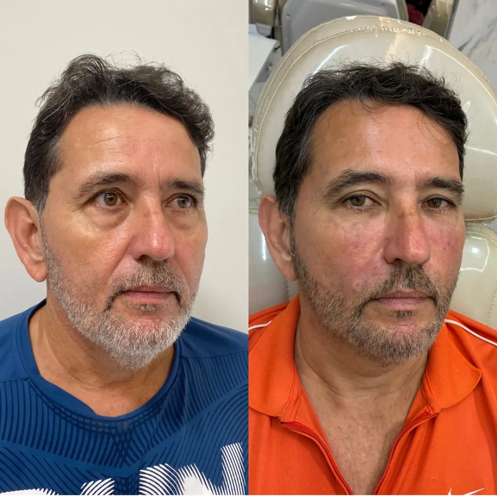 Antes e depois de tratamento facial na Cute & Capelli