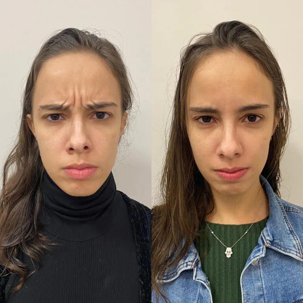 Antes e depois de tratamento facial na Cute & Capelli