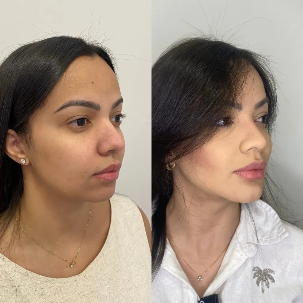 Antes e depois de tratamento facial na Cute & Capelli