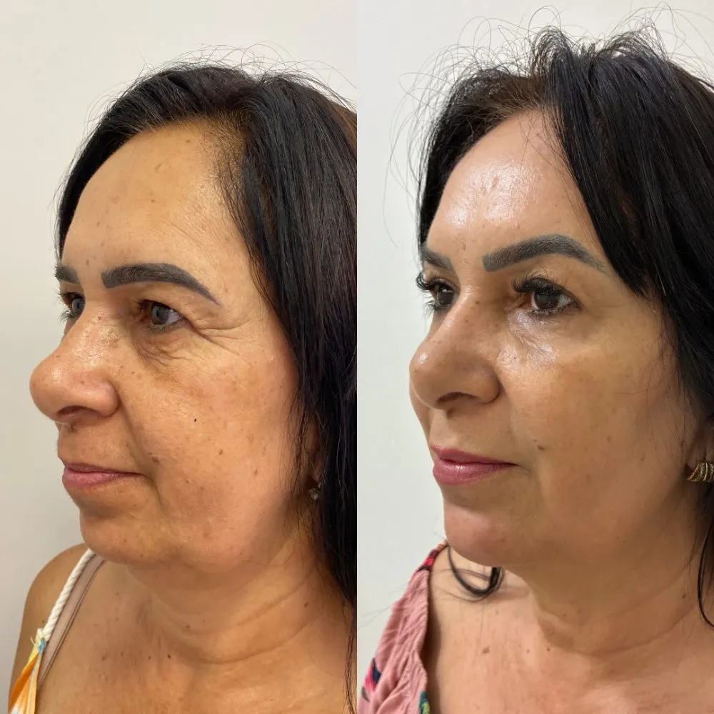 Antes e depois de tratamento facial na Cute & Capelli
