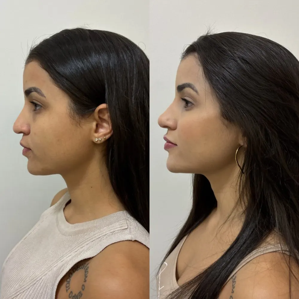 Antes e depois de tratamento facial na Cute & Capelli