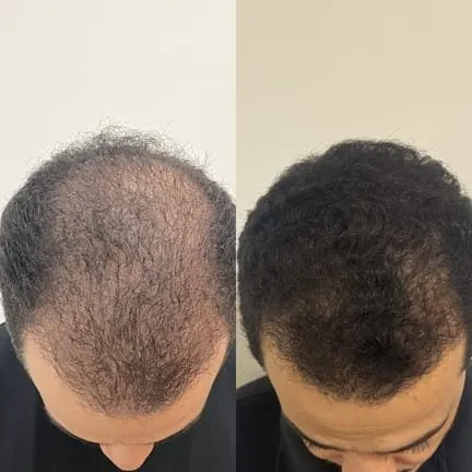 Antes e depois de tratamento capilar na Cute & Capelli