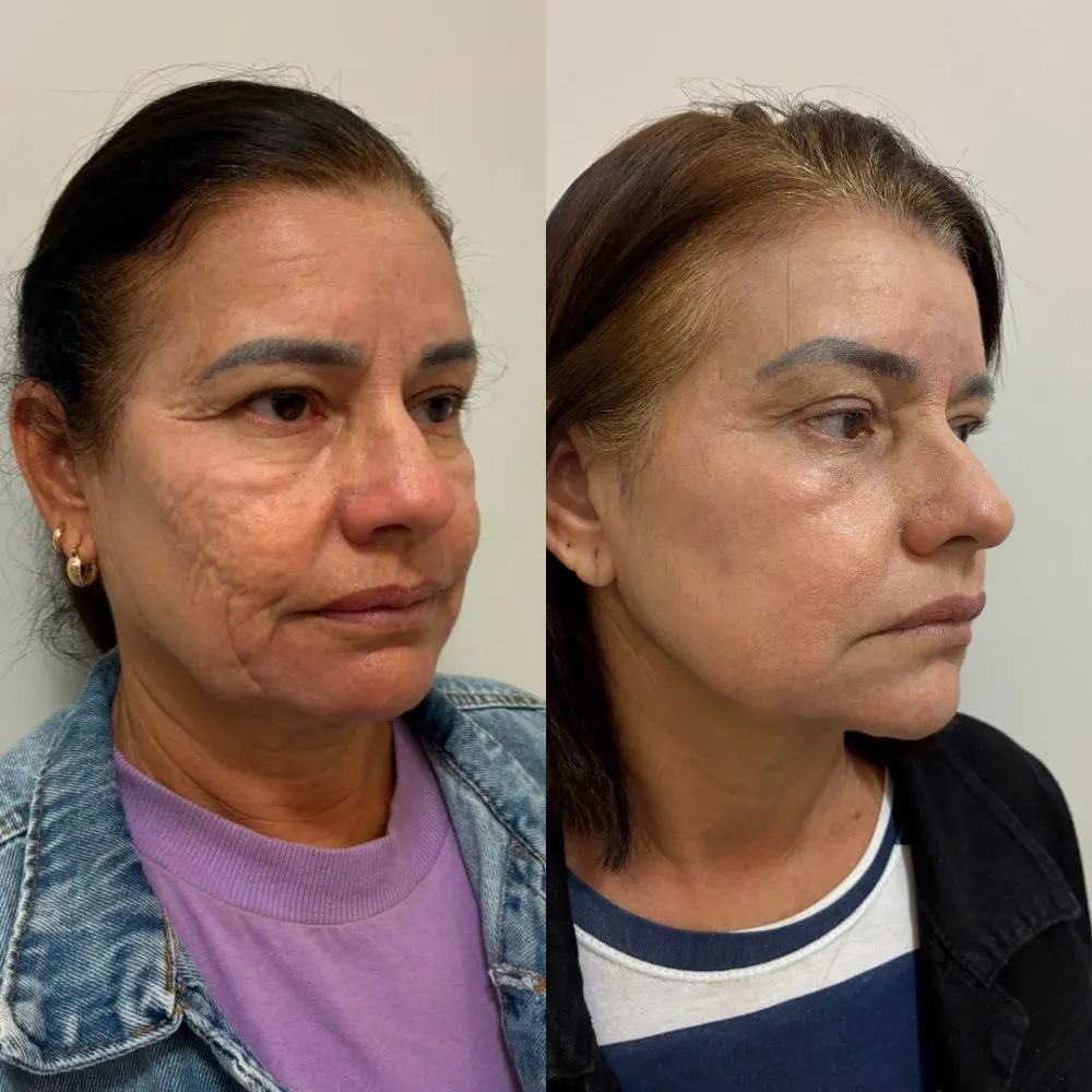 Antes e depois de tratamento facial na Cute & Capelli
