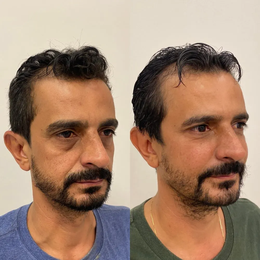 Antes e depois de tratamento facial na Cute & Capelli