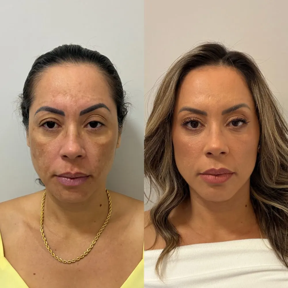 Antes e depois de tratamento facial na Cute & Capelli
