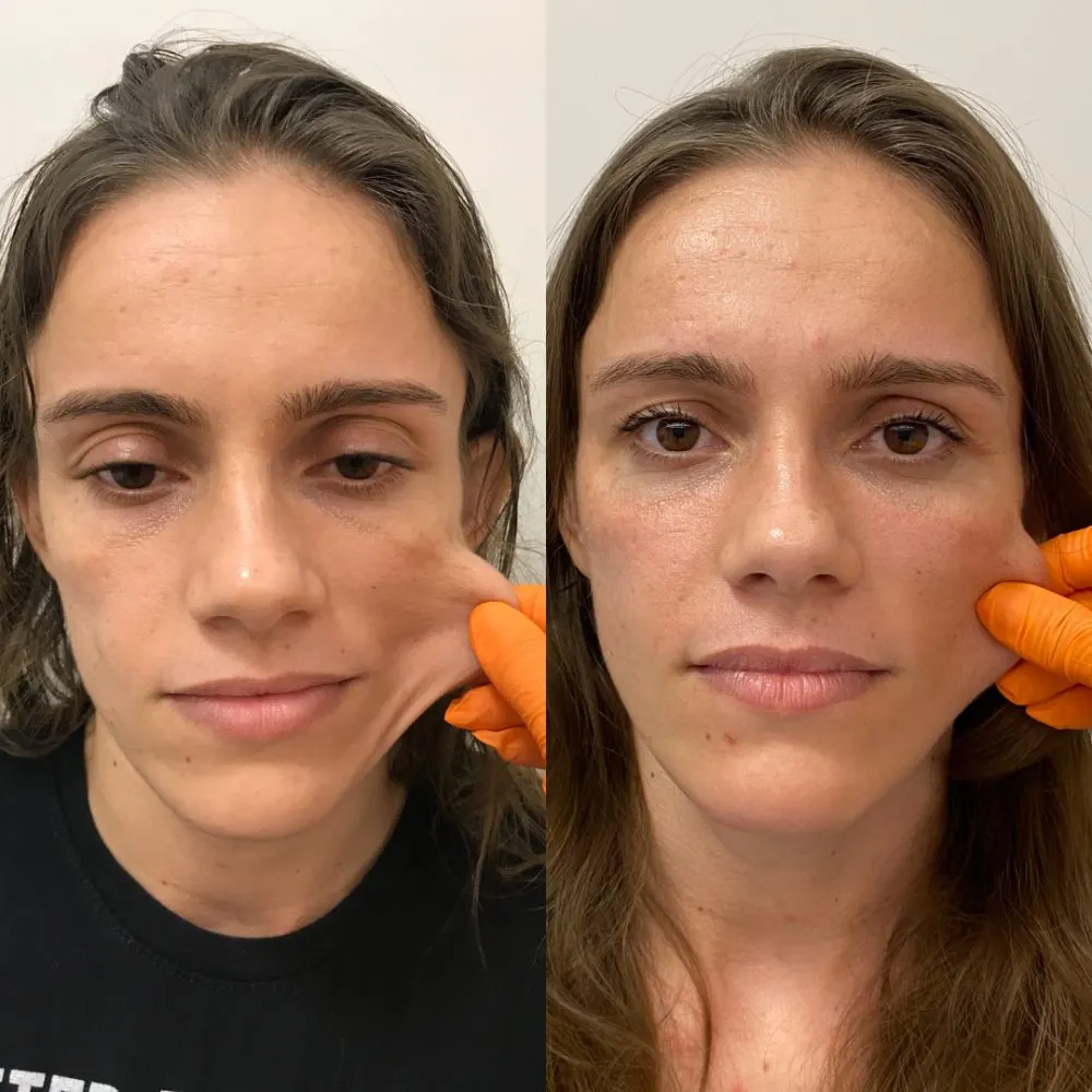 Antes e depois de tratamento facial na Cute & Capelli