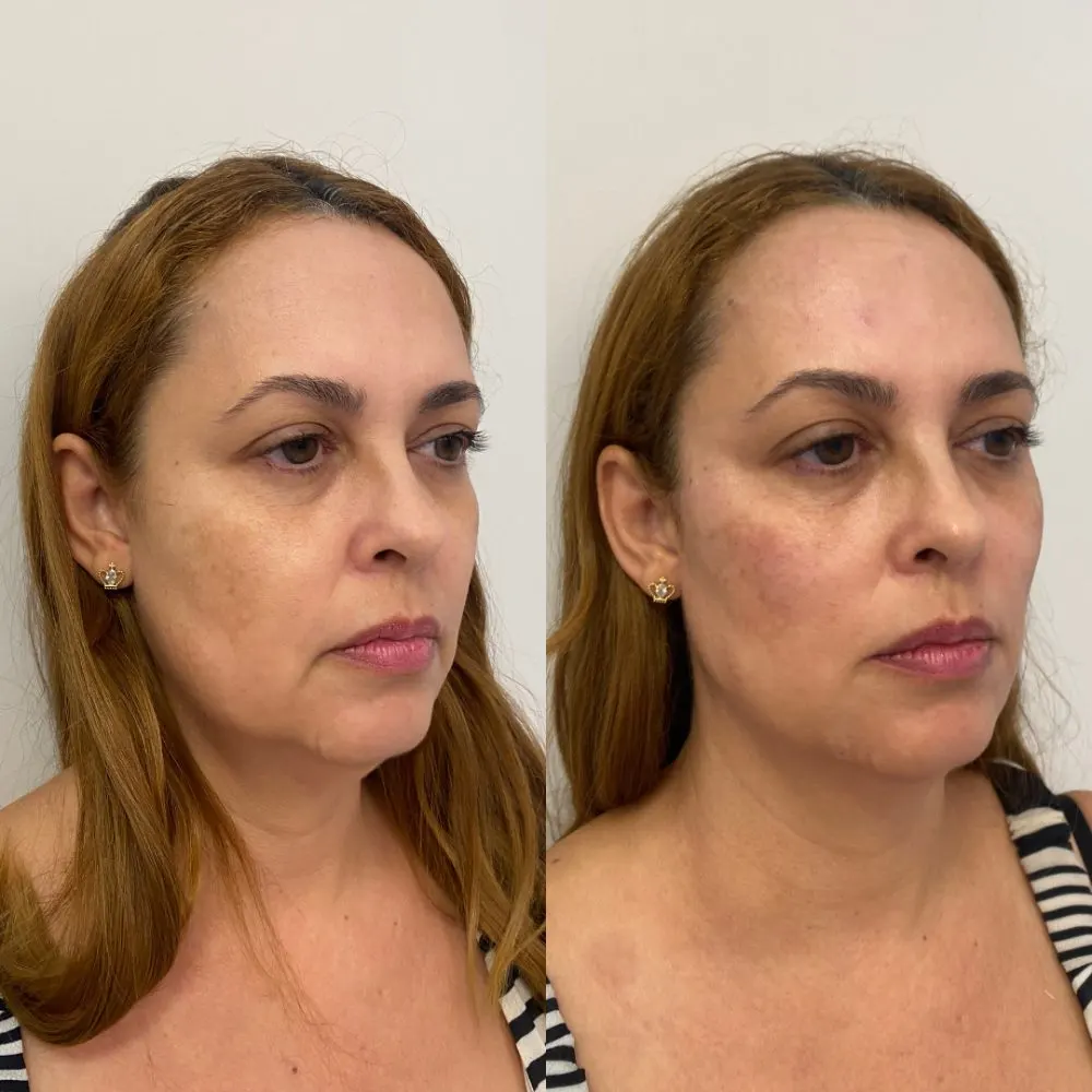 Antes e depois de tratamento facial na Cute & Capelli