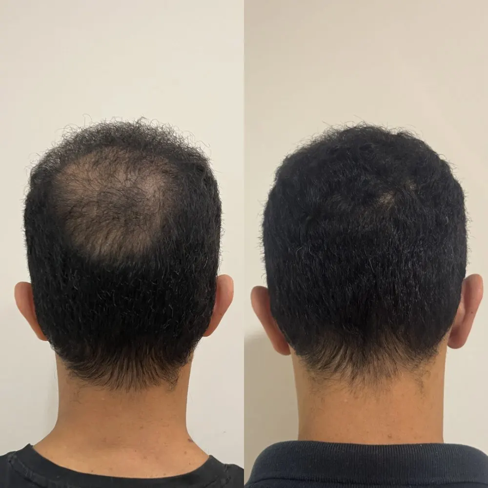 Antes e depois de tratamento capilar na Cute & Capelli