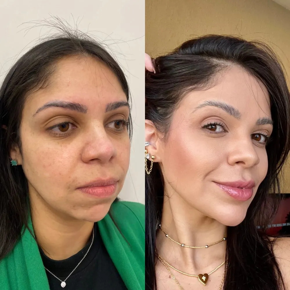 Antes e depois de tratamento facial na Cute & Capelli